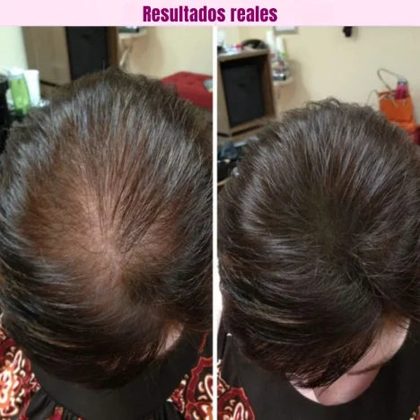 Capsulas caida pelo