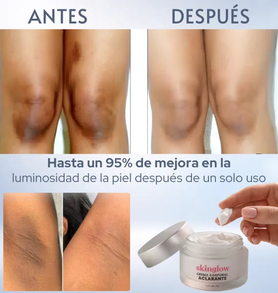 Crema acalara piel