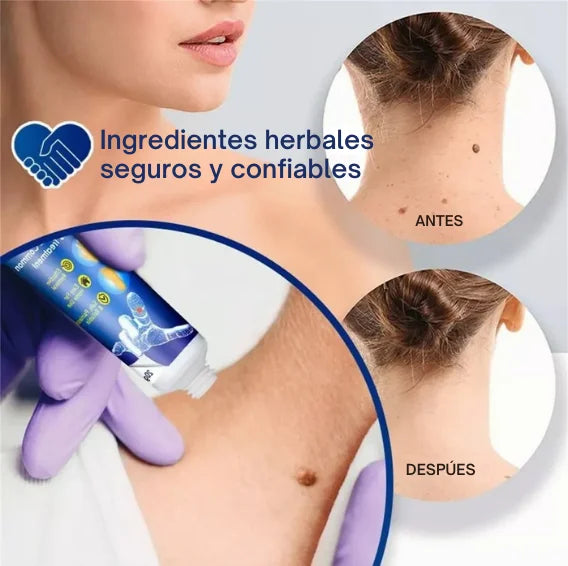 Removedor de Verrugas